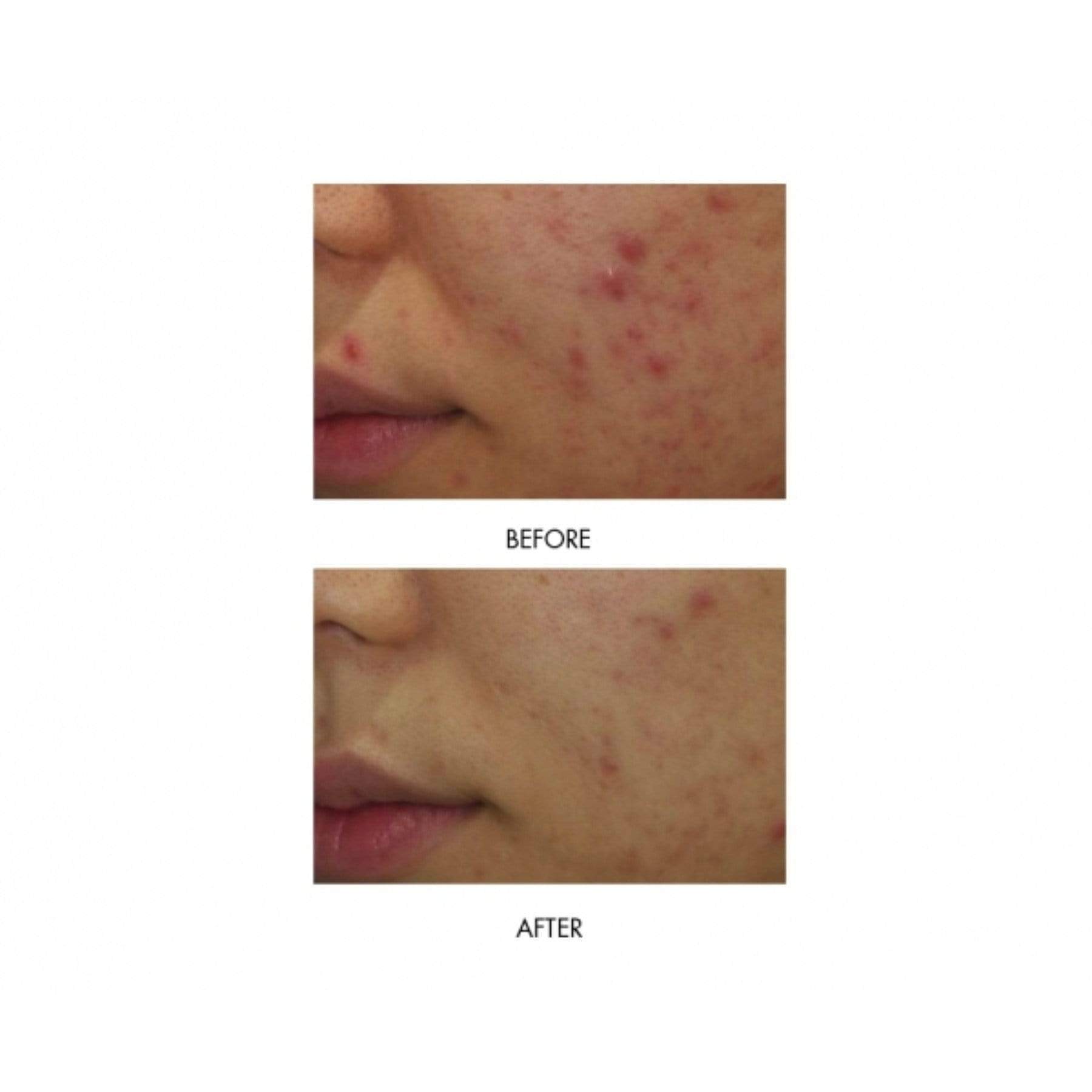 MIRENESSE ACNE 40g / 1.4oz Power Clear D-Blemish Treatment Gel Mini Kit X4 - Acne + Rosacea