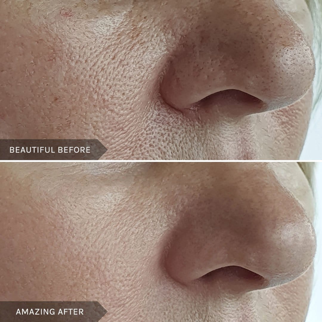MIRENESSE MASK Retinew Peel Mask -With Retinol/Lactic Acid/Rosehip Oil