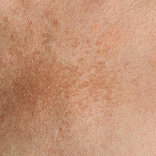 pigmentation