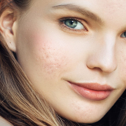 Acne Prone