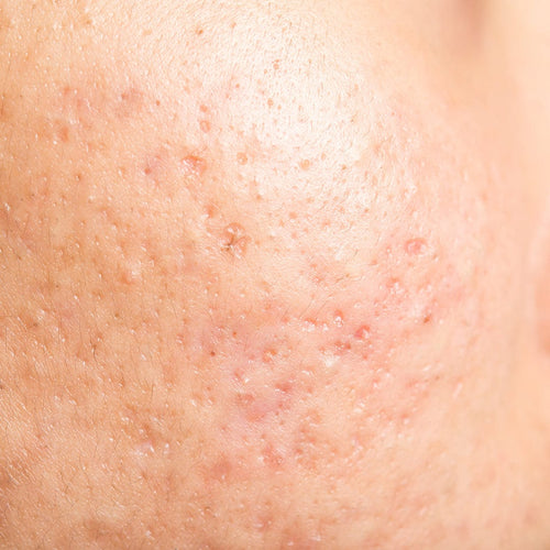 Oiliness + Acne Spots