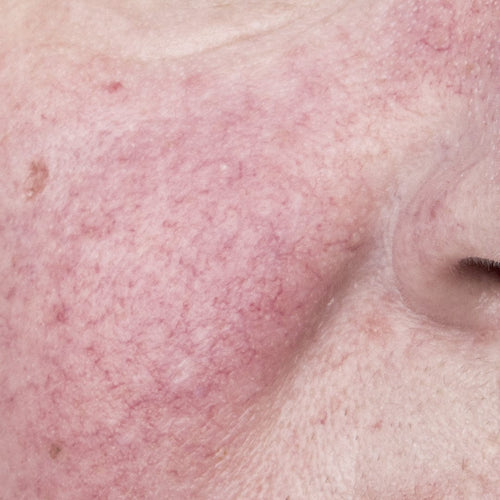 Sensitivity & Redness