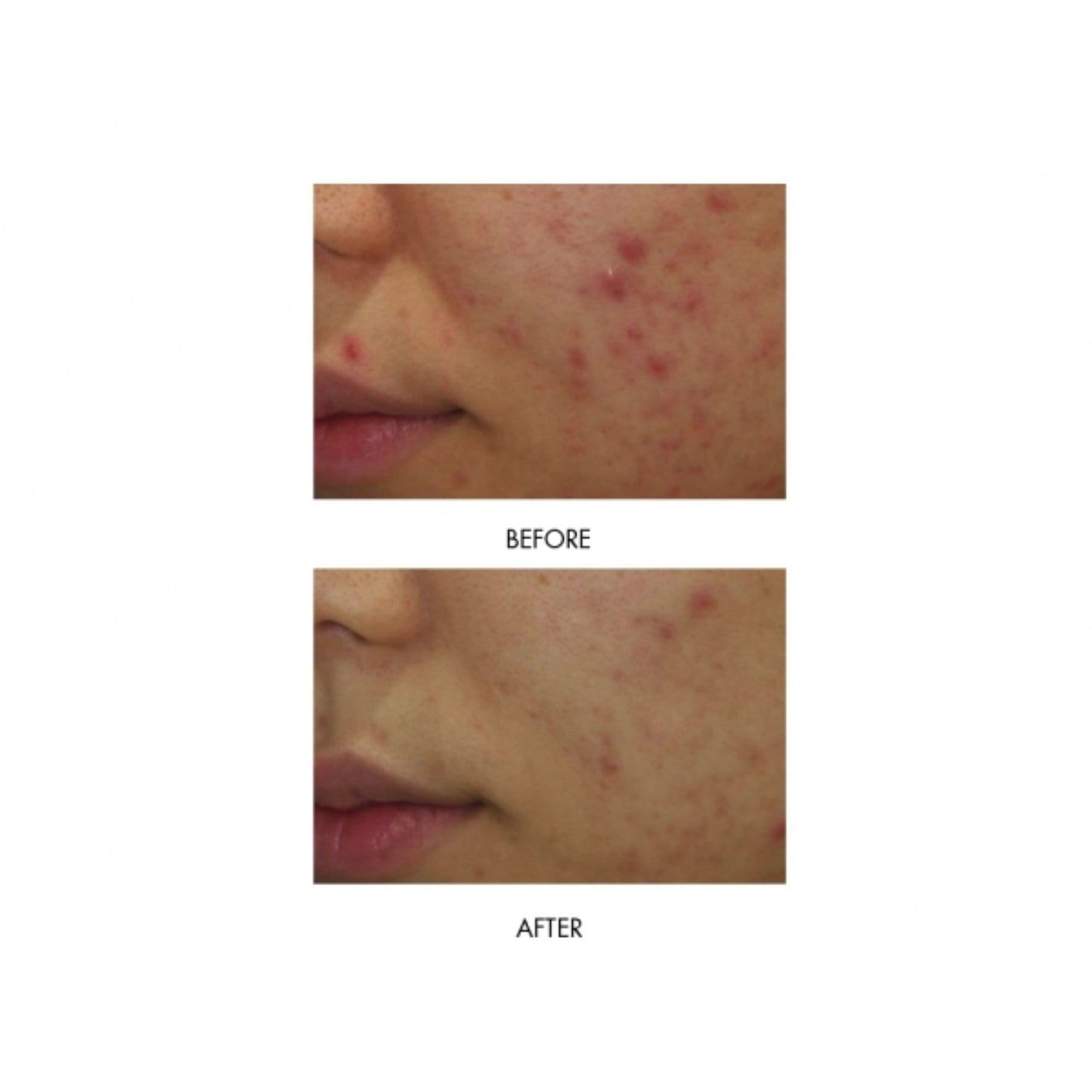 MIRENESSE ACNE 10g / 0.35oz Power Clear D-Blemish Treatment Gel Mini- Limit 5 - Acne + Rosacea