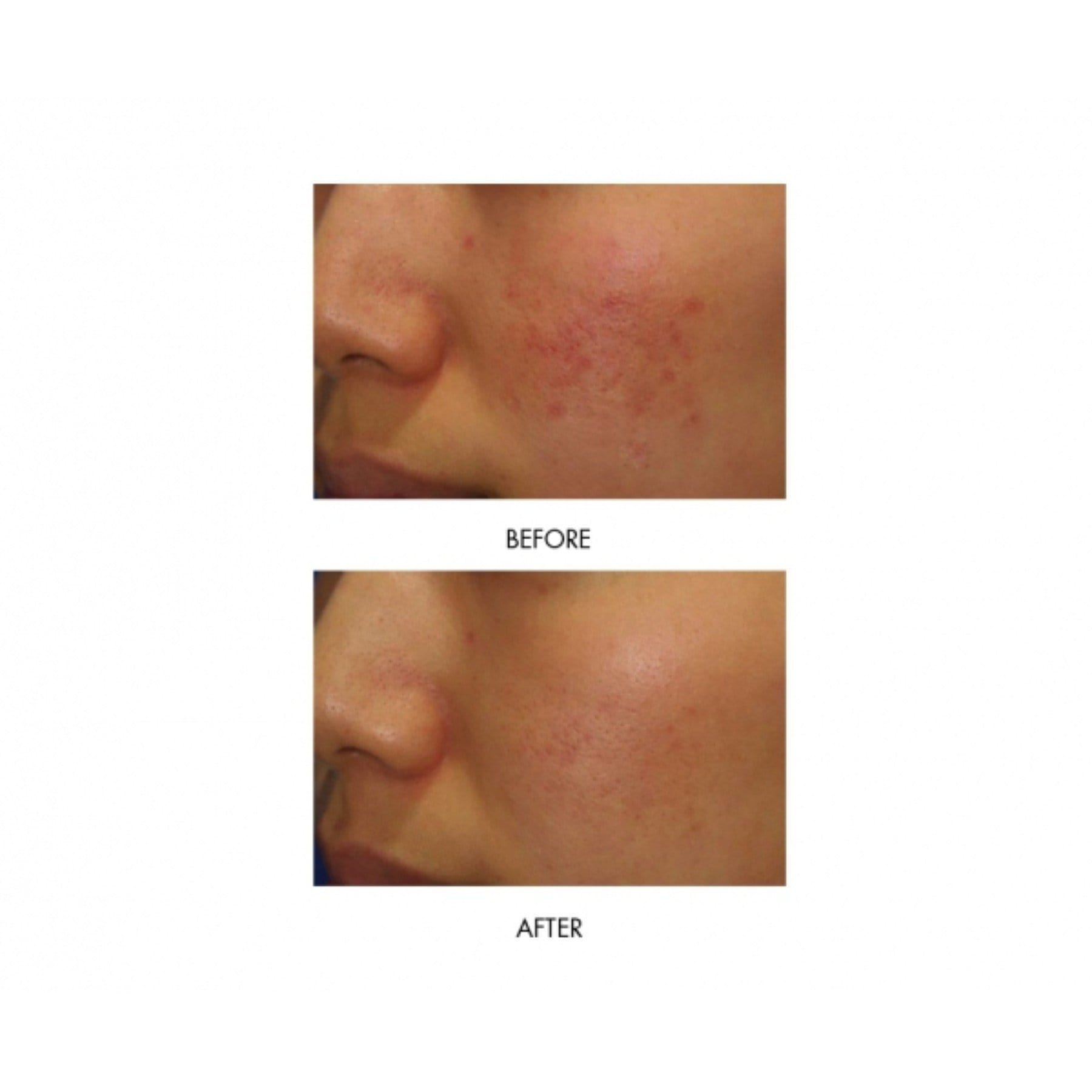 MIRENESSE ACNE 10g / 0.35oz Power Clear D-Blemish Treatment Gel Mini- Limit 5 - Acne + Rosacea