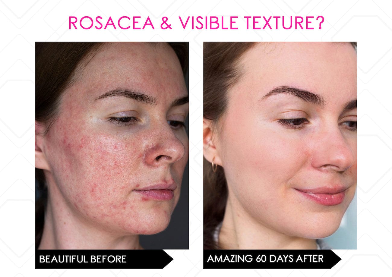 Mirenesse ANTIAGEING Limited Stock* Skin Secrets Pro Kit Amazing LED Mask - Red Led+7 in 1 Treatments FDA Cleared