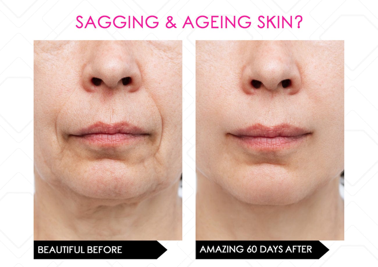 Mirenesse ANTIAGEING Limited Stock* Skin Secrets Pro Kit Amazing LED Mask - Red Led+7 in 1 Treatments FDA Cleared